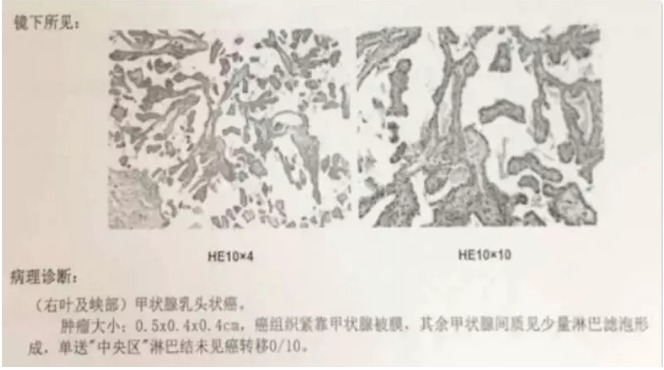 別慌，甲狀腺疾病還可以這樣投保！